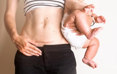 Hồi Phục Sau Sinh Mổ: 7 Bước Chăm Sóc Vết Thương Đúng Cách Tại Nhà